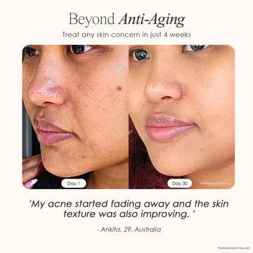 Nuvio High Frequency Acne Wand